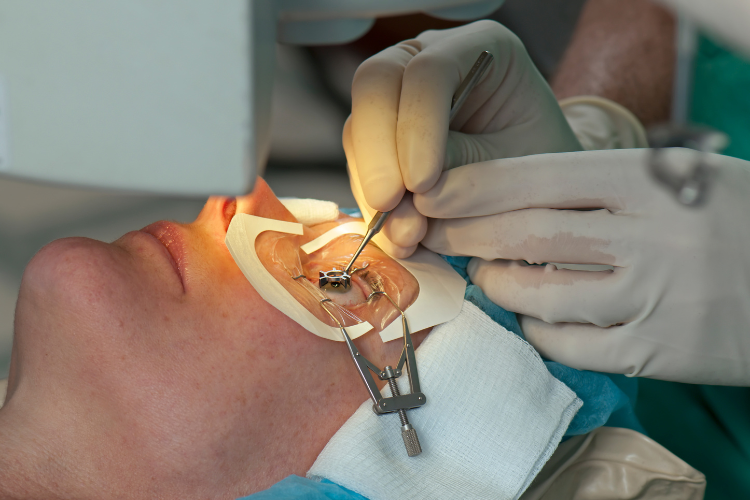 keunggulan prosedur lasik 