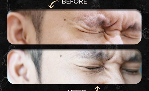 Hasil Pico Laser